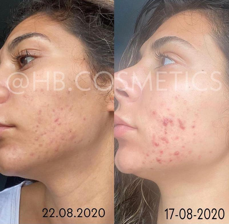 CLENZIderm M.D.® Acne Therapeutic System