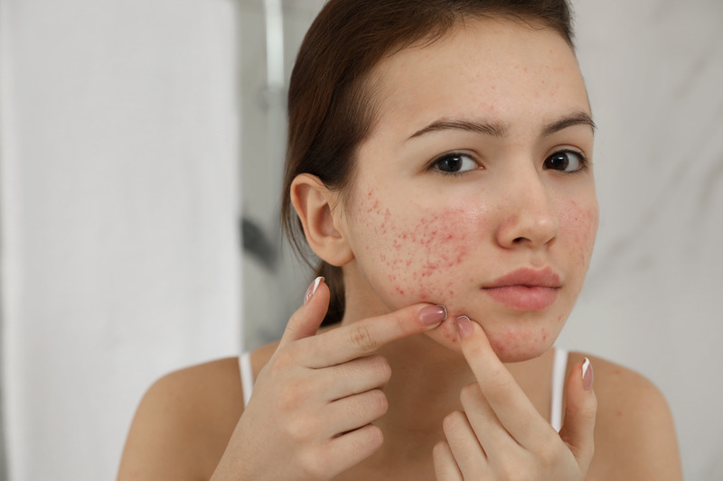 Acne & Breakouts