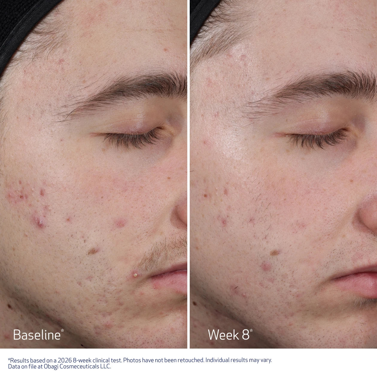 CLENZIDERM M.D. Resurfacing Multi-Acid Peel Pads - Image 7