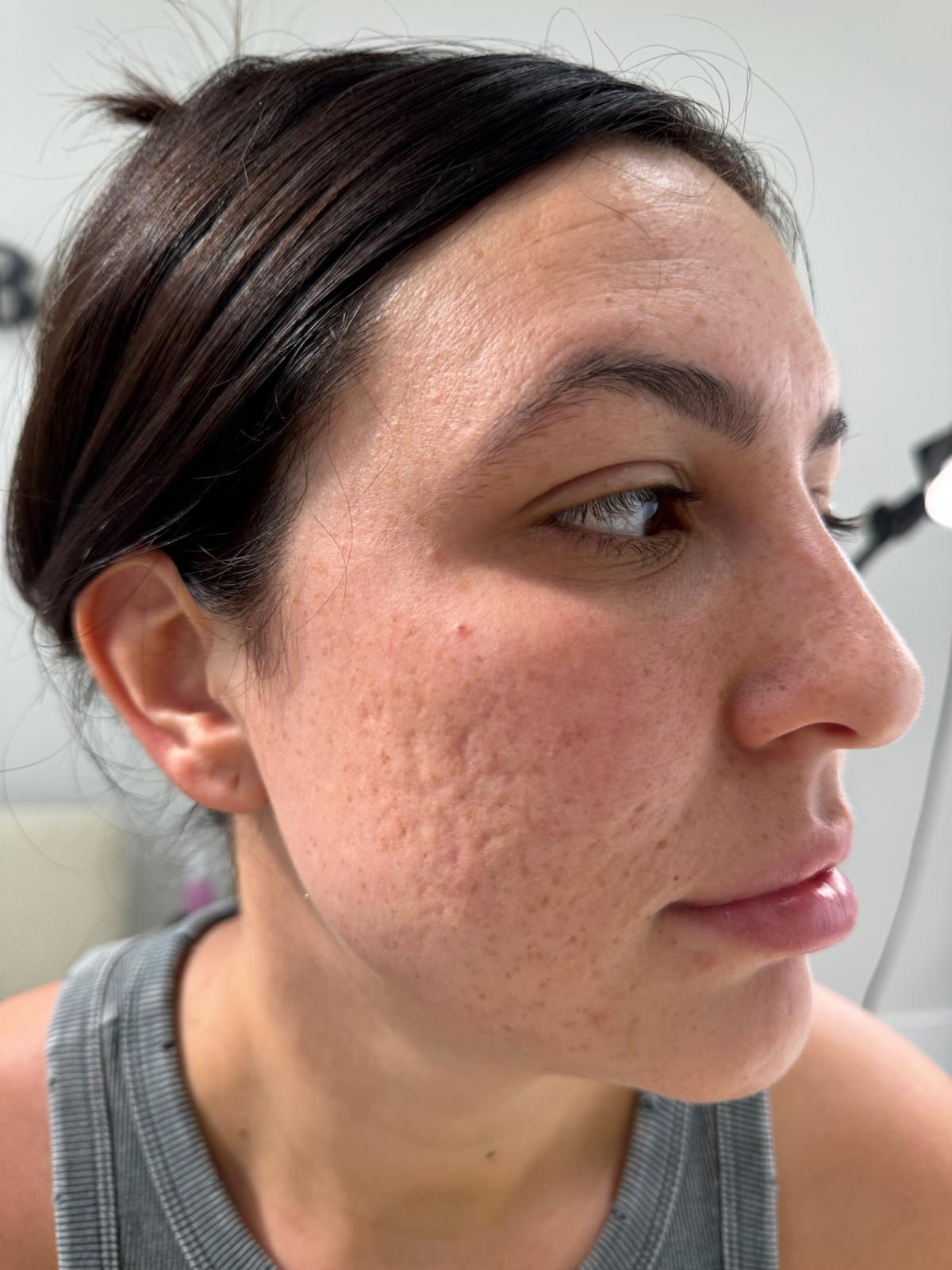 Before co2 laser resurfacing treatment