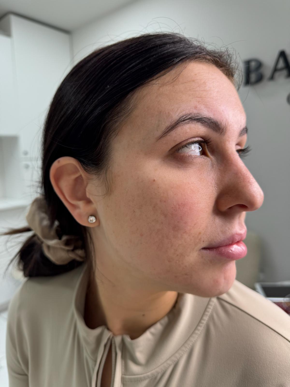 After co2 laser resurfacing treatment