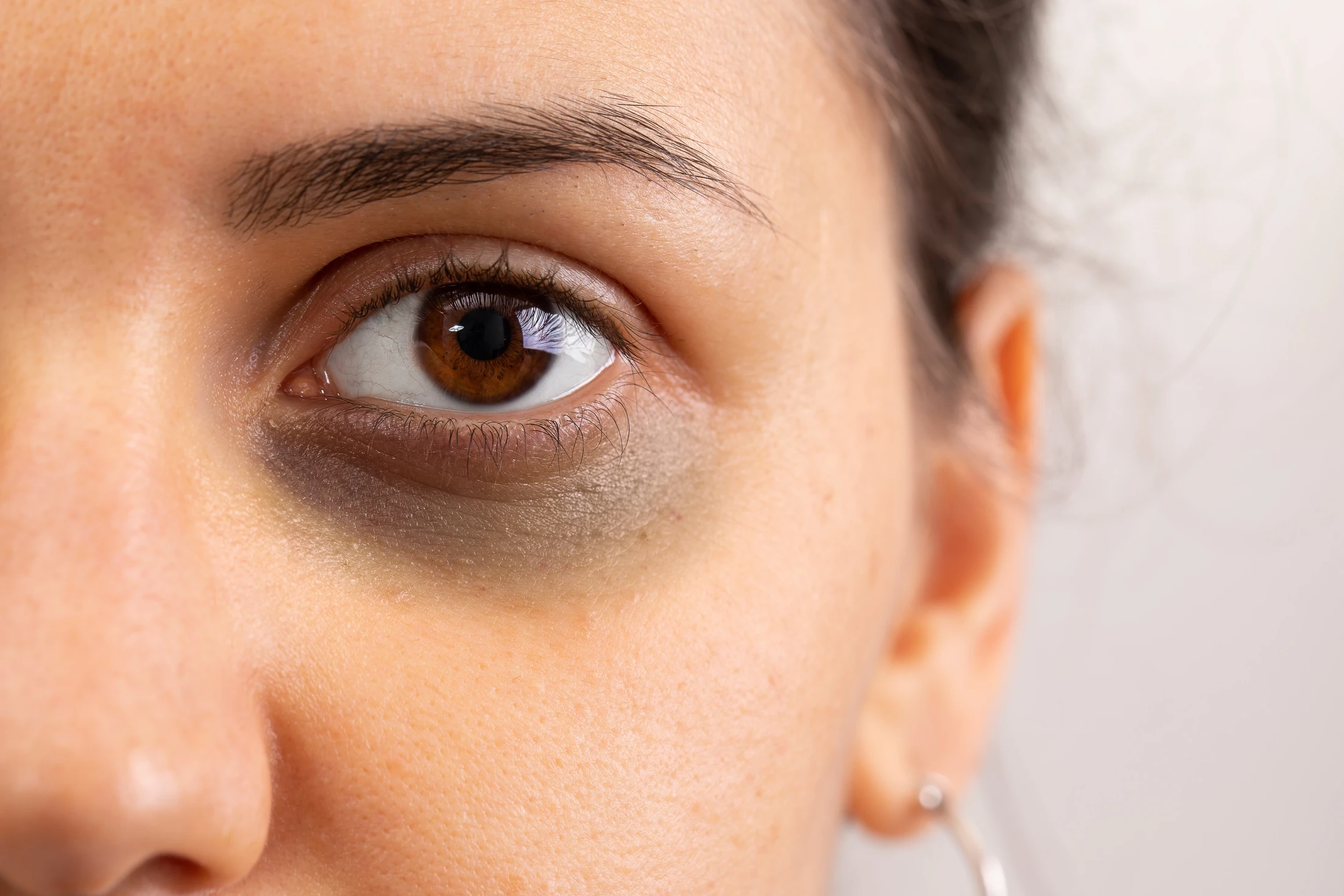 Dark Circles