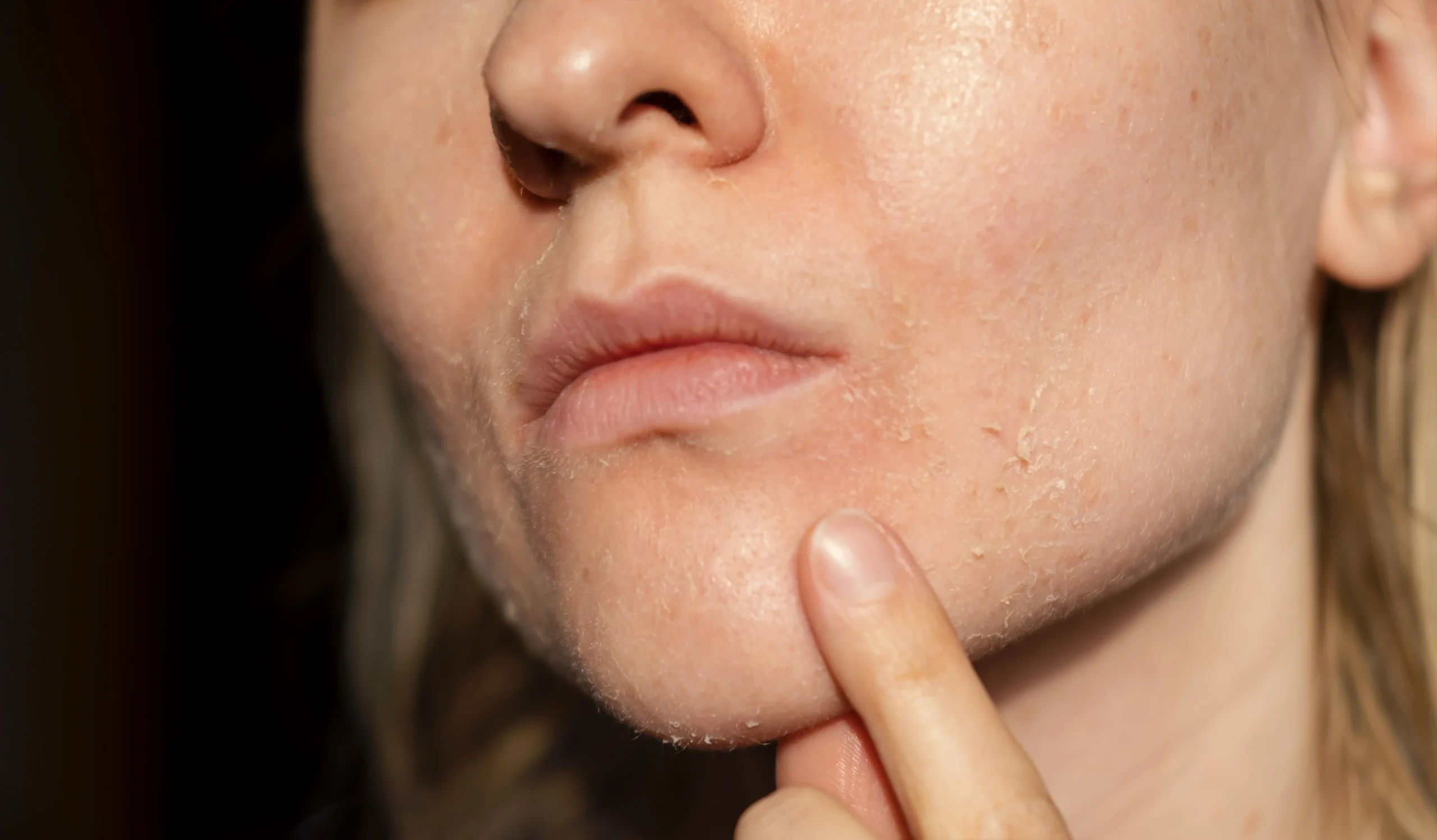 Dryness & Redness