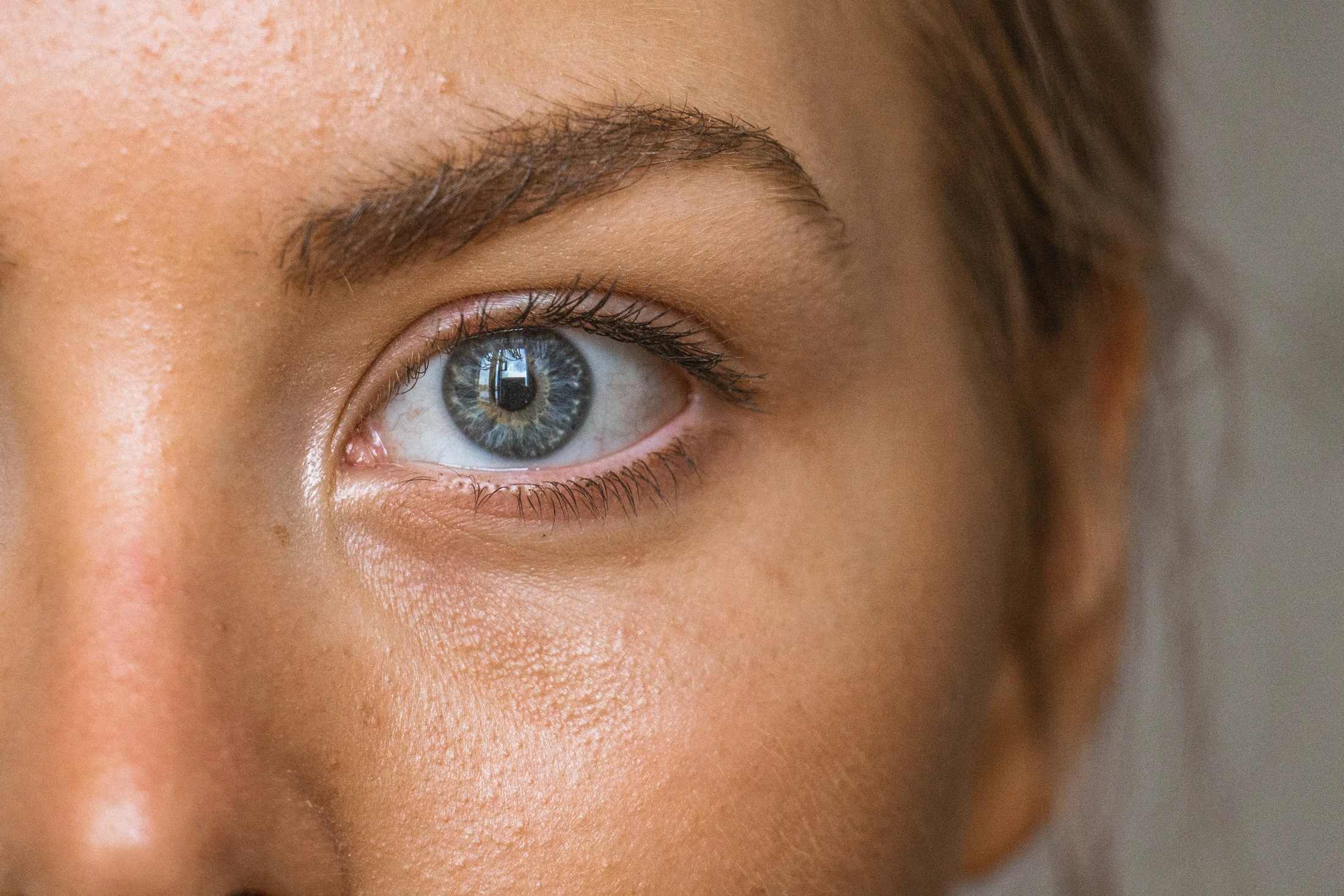 Under-Eye Lines & Puffiness