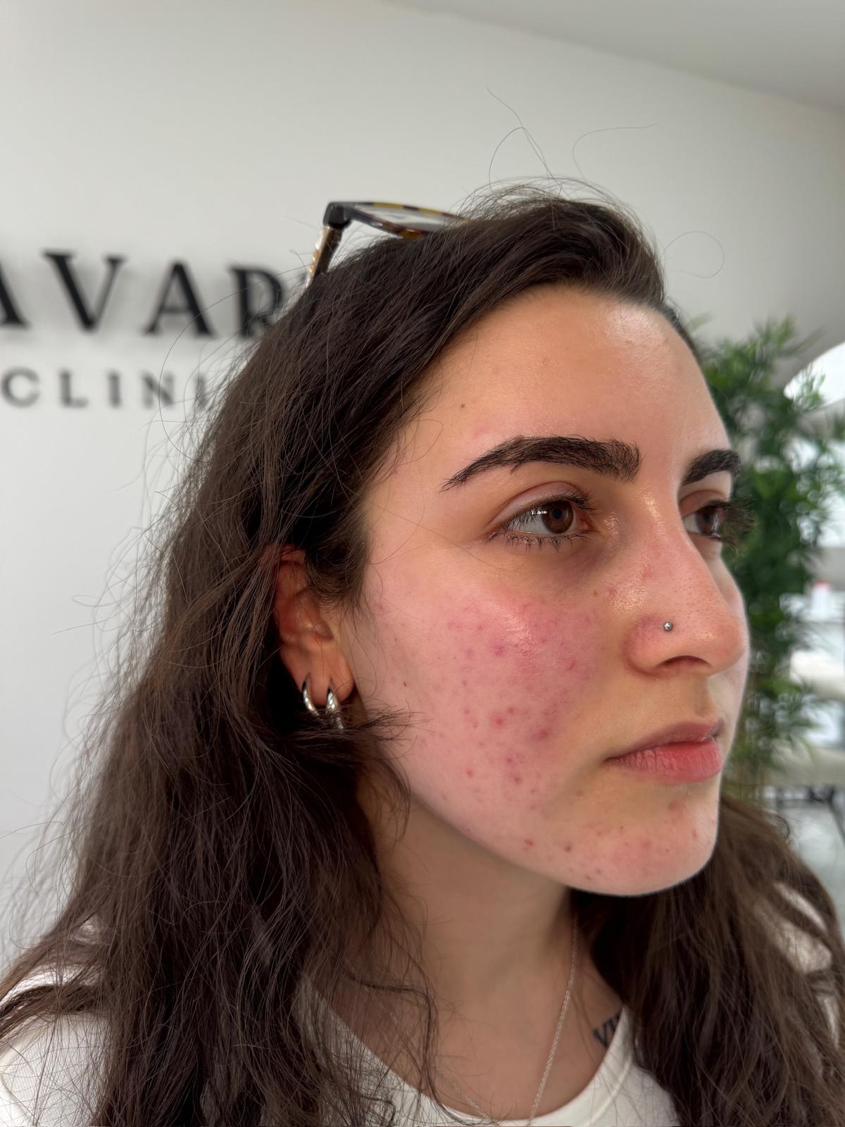 Before rosacea ipl treatment