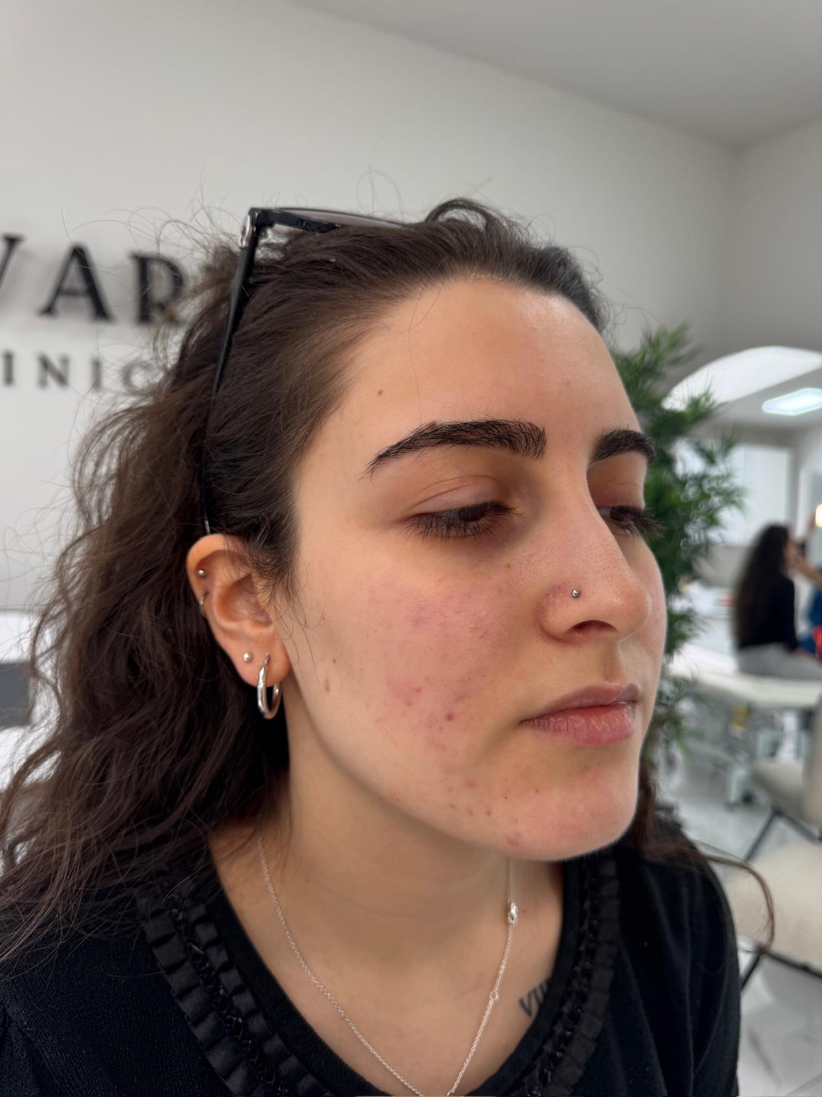 After rosacea ipl treatment