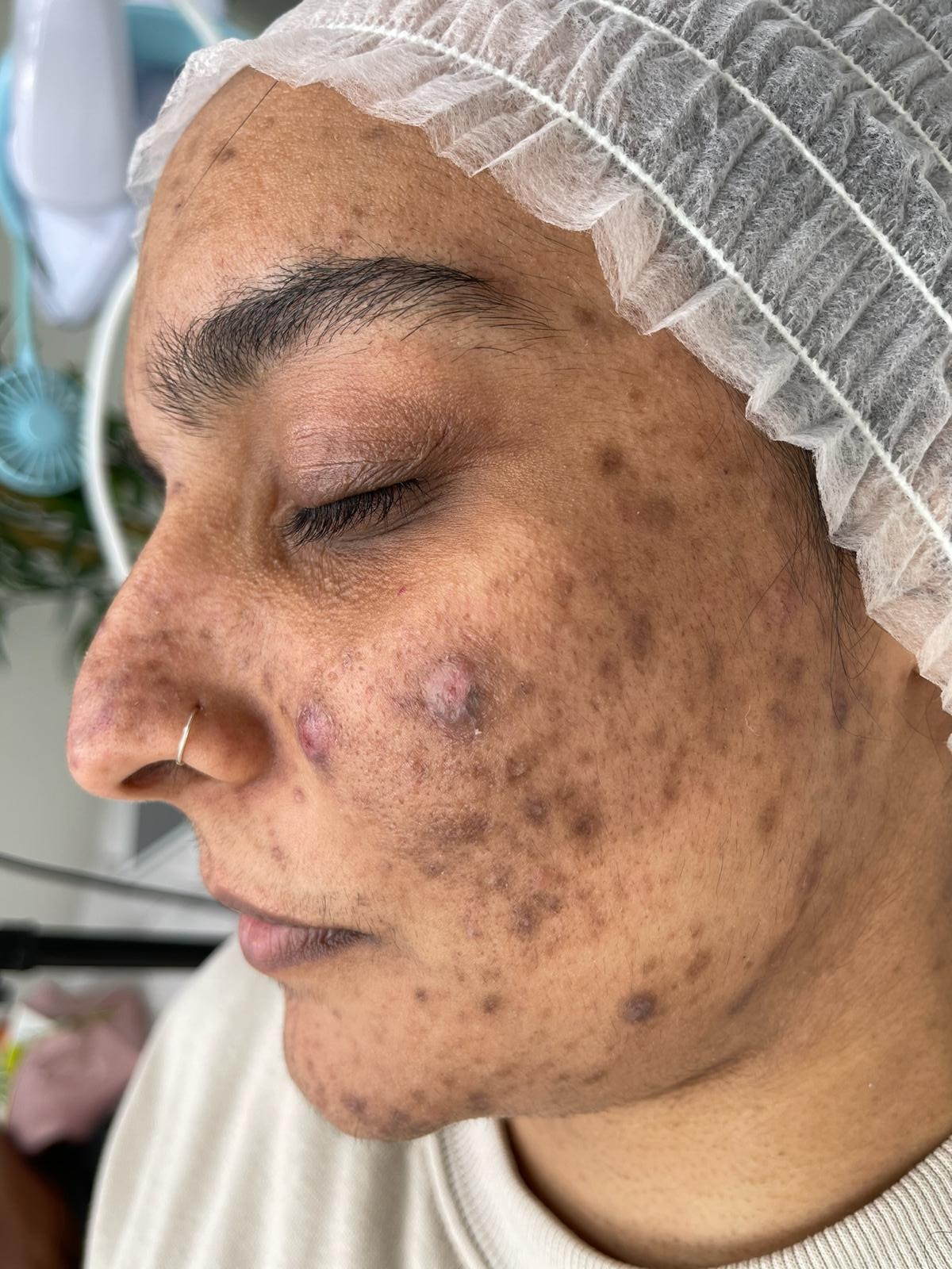 Before perfect peel treatment