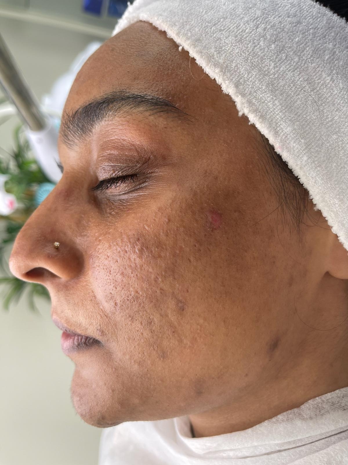 After perfect peel treatment